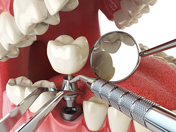 Best Emergency Broken Tooth Repair in Henderson, KY